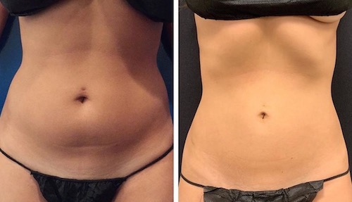 Lipo 360 NYC, Cost