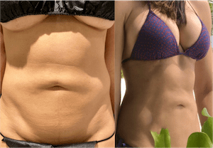 nps_before-after-double-reverse-mini-tummy-tuck-min