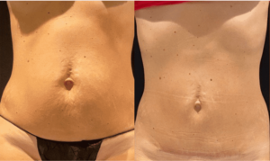 nps_before-after-moderate-skin-lipo-360-min