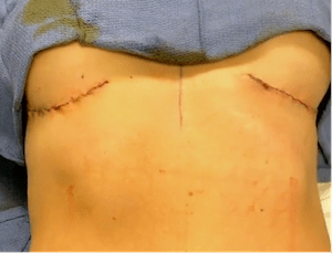 nps_double-reverse-tummy-tuck-scars-min