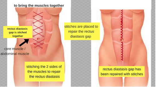nps_reverse-tuck-muscle-repair-min