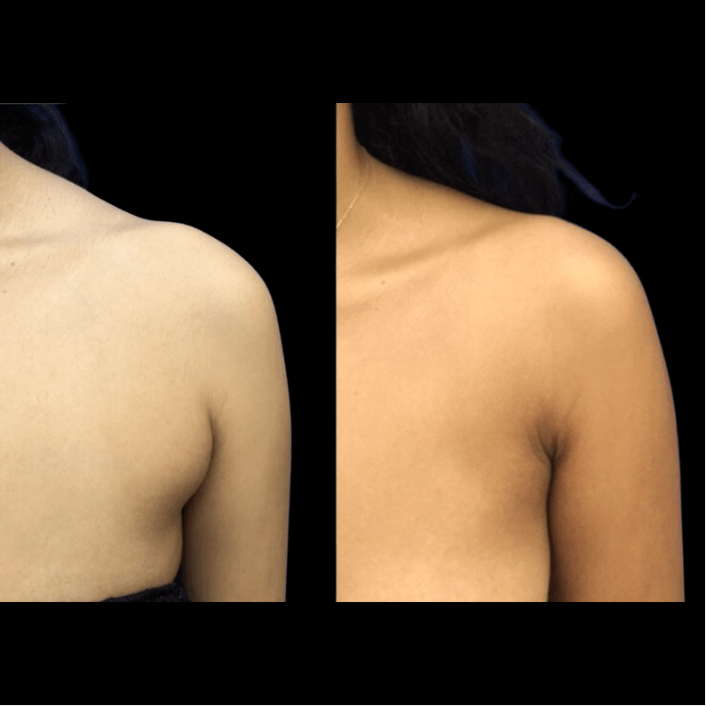 Premium Vector  Armpit fat before and after brachioplasty, liposuction or  plastic surgery, woman body shape transfo