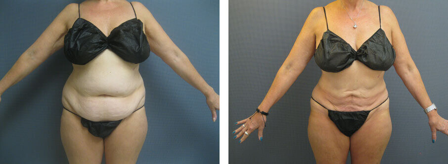 Abs And Waist Liposuction Before And After Neinstein Plastic Surgery