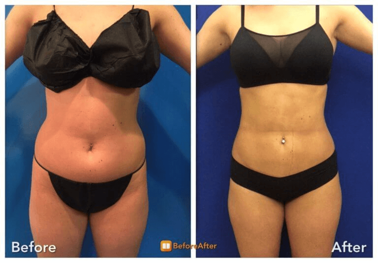 Tumescent Liposuction in NYC - Neinstein Plastic Surgery