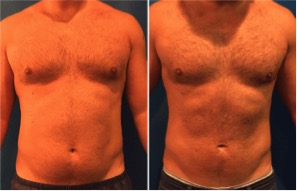 NYC Liposuction Specialist | Upper East Side | Neinstein Plastic Surgery