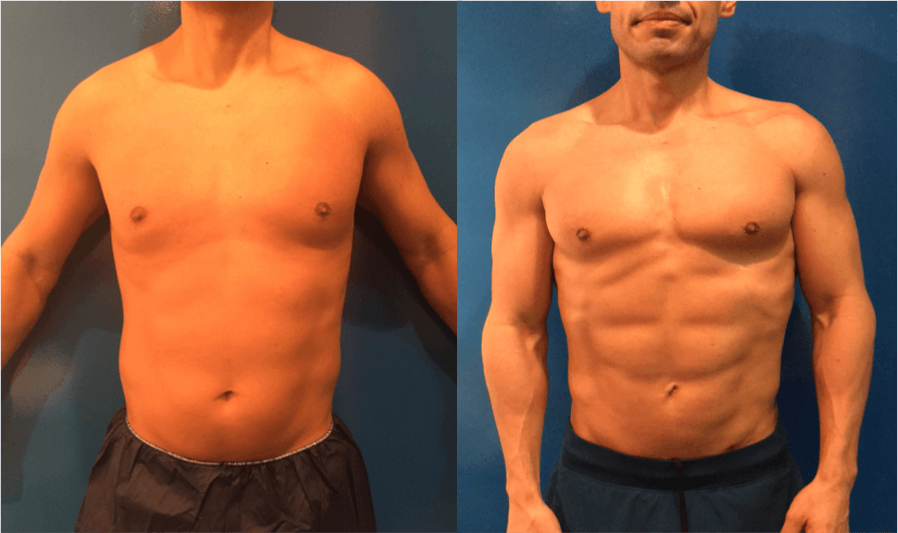 Before & After: Male Liposuction Results | Neinstein Plastic Surgery