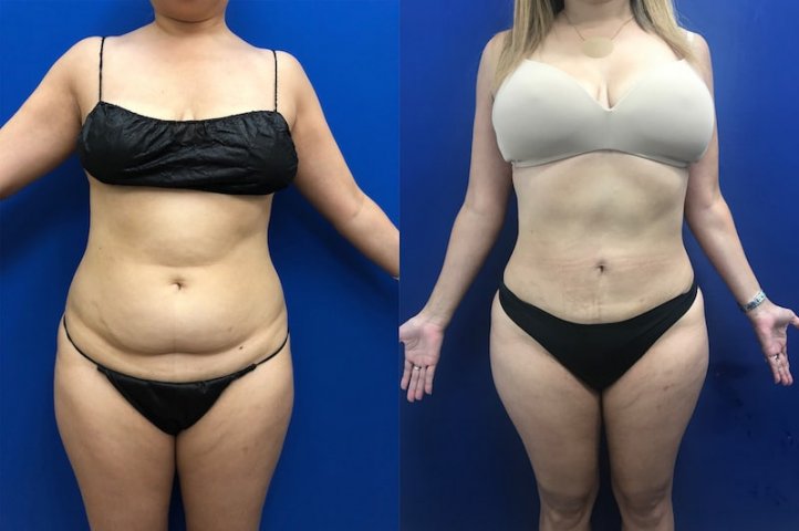 dealing-with-loose-skin-after-undergoing-liposuction-yeg-fitness