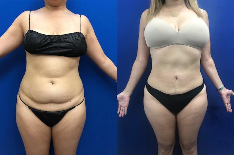 female-abs-lipo-before-after