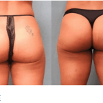 emsculpt-butt-lift