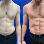 emsculpt-before-after-male-abs