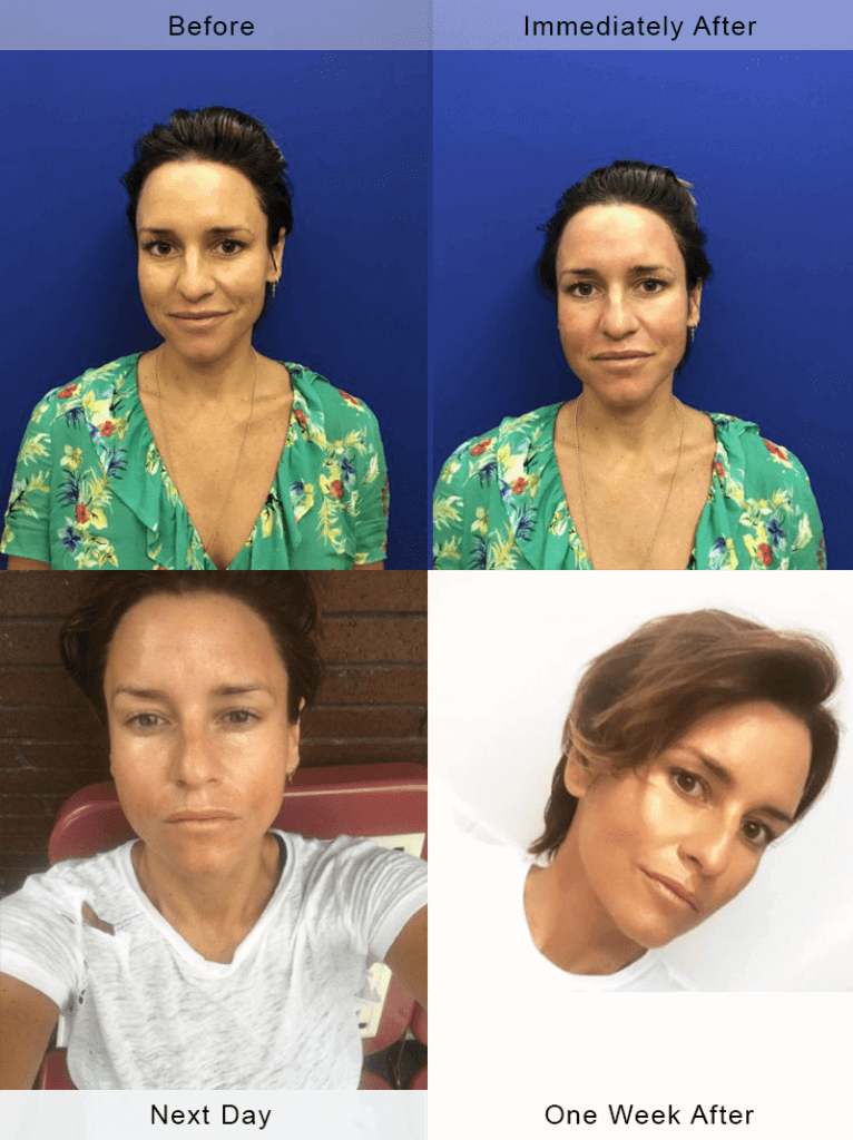 microneedling-before-after