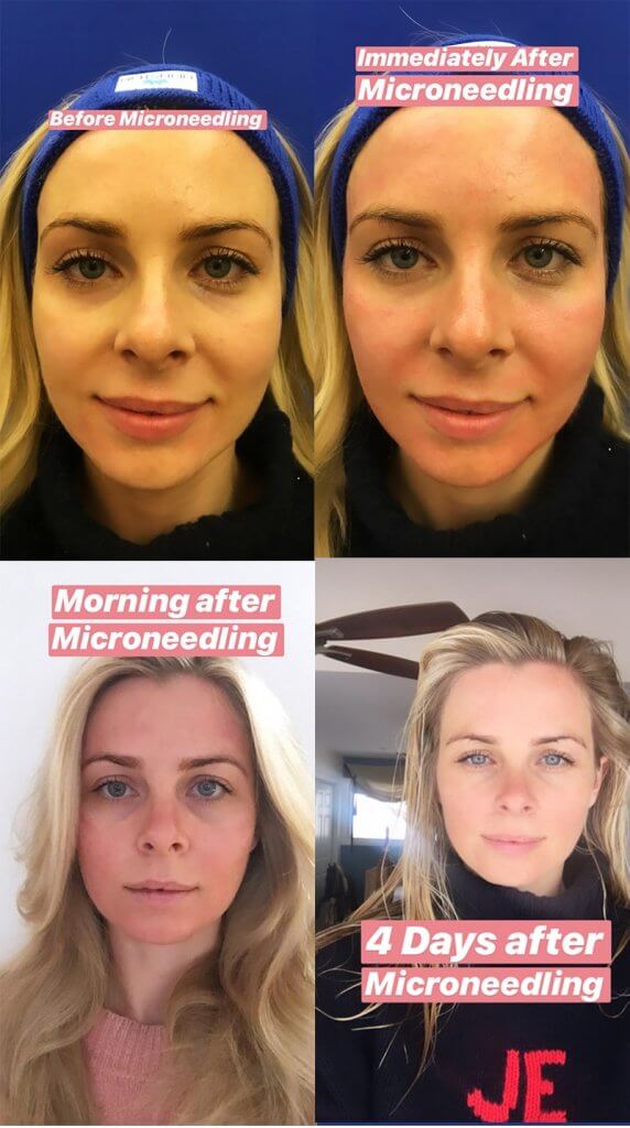 Microneedling Skin Rejuvination In Nyc Neinstein Plastic Surgery