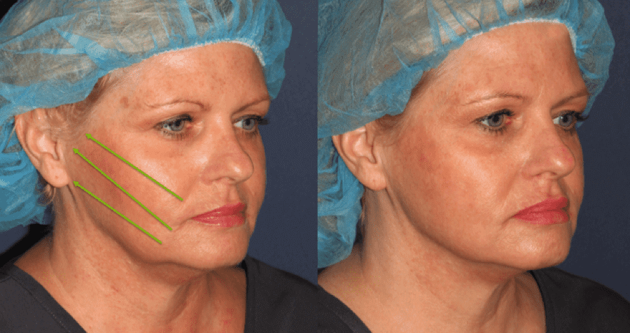 facelift-before-after