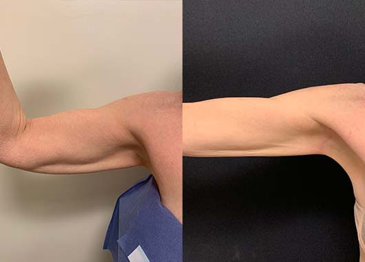 Before & After: Arms Liposuction | Neinstein Plastic Surgery