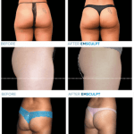 emsculpt-before-after-butt-lift