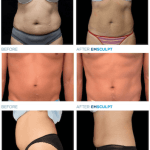 emsculpt-before-after-stomach