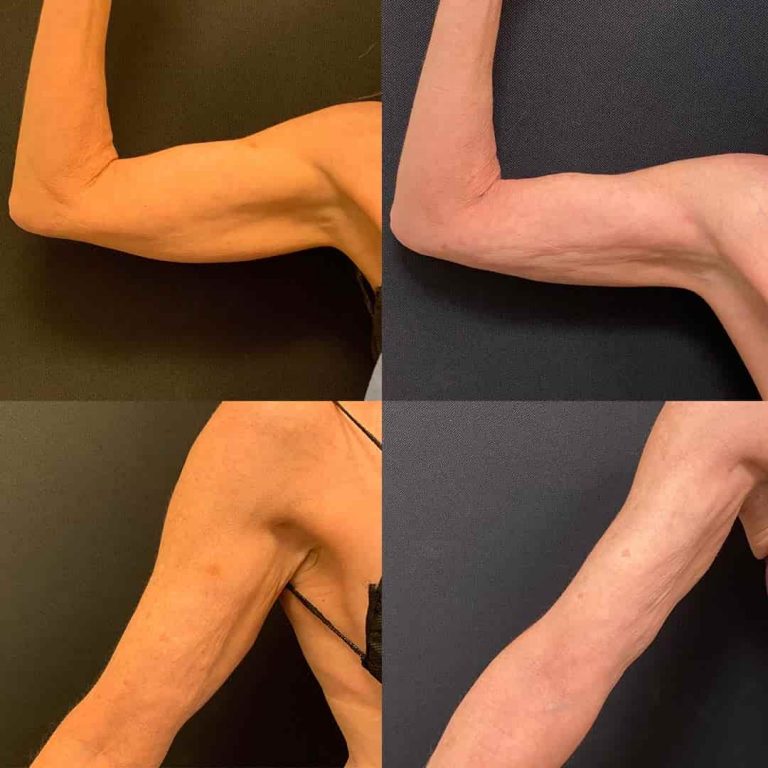 Before & After: Arms Liposuction | Neinstein Plastic Surgery