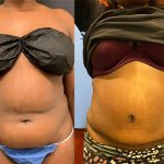 before-after-female-coolsculpting