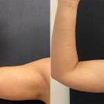 before-after-female-arm-liposuction