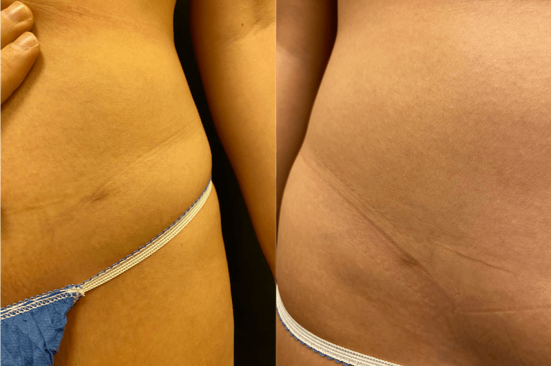 skinuva-before-after-min