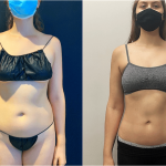 nps_before-after-lipo360-front-12.8-min