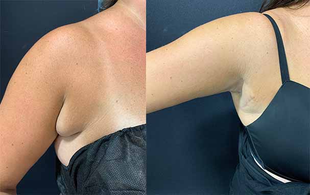 Arm Pit & Bra Bulge Lipo Before & After | Neinstein Plastic Surgery