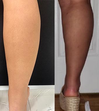 Calf and Ankle Liposuction: What's Surgery and Recovery Like?