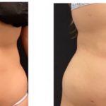 NPS_coolsculpting-revision-before-after-2.17