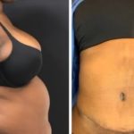 NPS_coolsculpting-revision-before-after-2.17-4