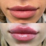 NPS_lip-fillers-before-after-2.17-1-min