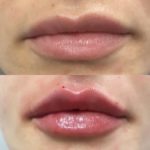 NPS_lip-fillers-before-after-2.17-2-min