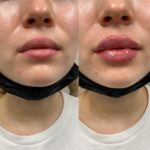 NPS_lip-fillers-before-after-2.17-3-min