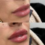 NPS_lip-fillers-before-after-2.17-4-min