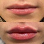 NPS_lip-fillers-before-after-2.17-5