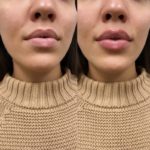 NPS_lip-fillers-before-after-2.17-7-min
