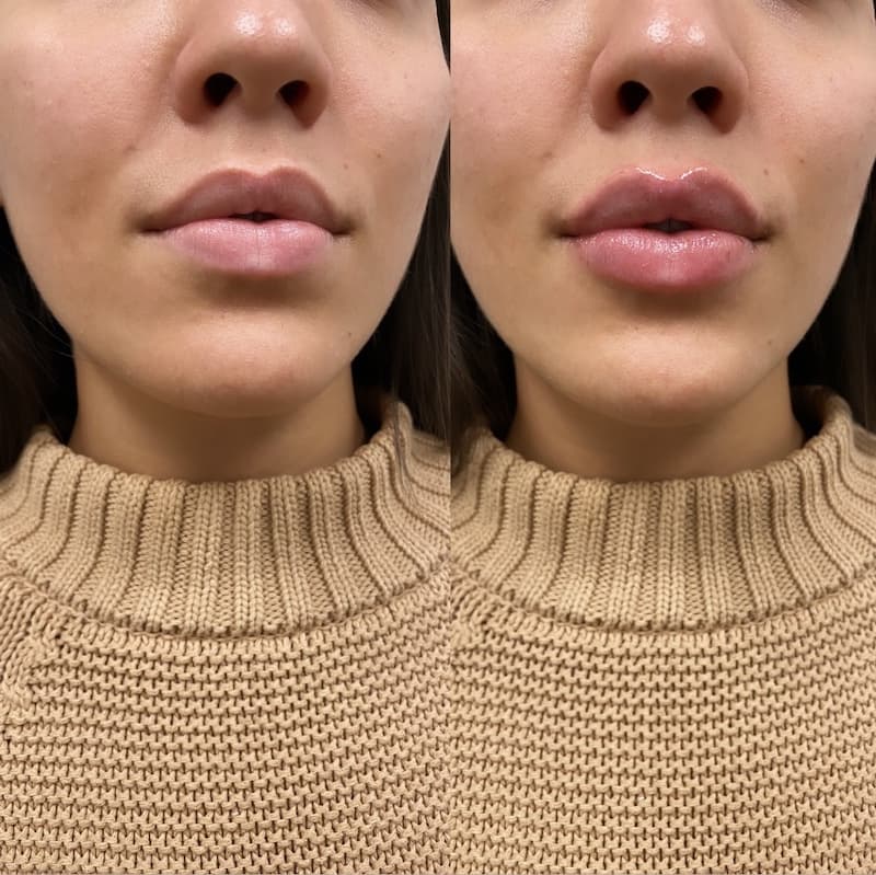 How Much are Lip Fillers?  