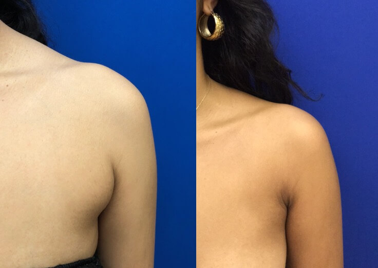 Arm Pit &amp;amp; Bra Bulge Lipo Before &amp;amp; After | Neinstein Plastic Surgery