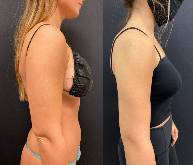Before & After: Arms Liposuction - Neinstein Plastic Surgery