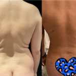nps_before-after-back-lipo-2.23-min