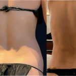 nps_before-after-back-waist-lipo-2.23-min