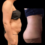 nps_coolsculpting-revision-female-profile