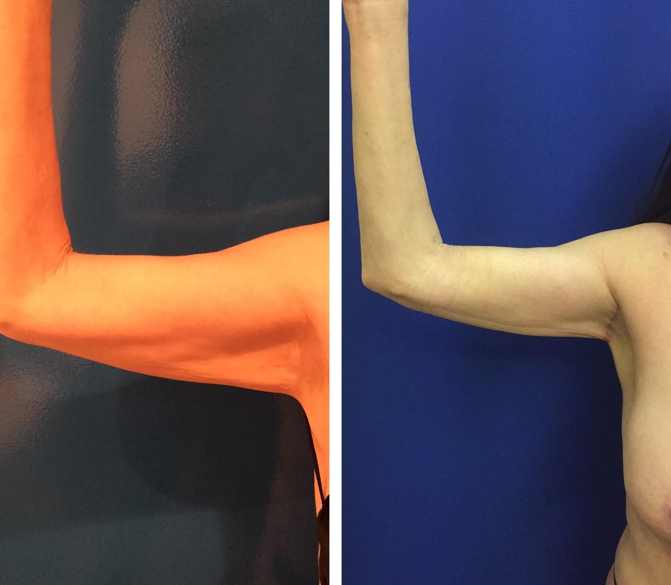 Before & After: Arms Liposuction - Neinstein Plastic Surgery