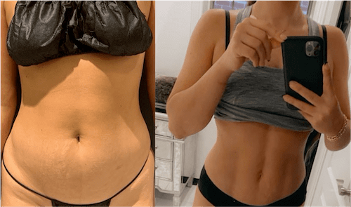 NPS_before-after-lipo360-3.1-min