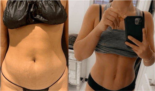 Lipo For Women Before & After NYC