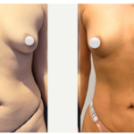 NPS_funderburk-before-after-abdominoplasty-2.16-1-min