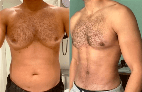 Male Breast Reduction/Gynecomastia New York City