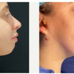 NPS_funderburk-before-after-neck-lipo