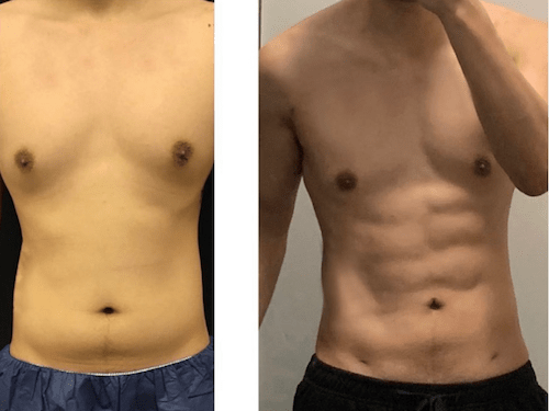 Six Pack Surgery - Apex Clinic