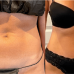 nps_before-after-abdomen-3.16