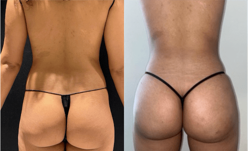 Mini Brazilian Butt lift (bbl) vs Brazilian Butt Lift